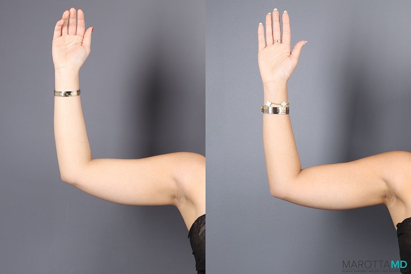 Emsculpt Neo Before & After
