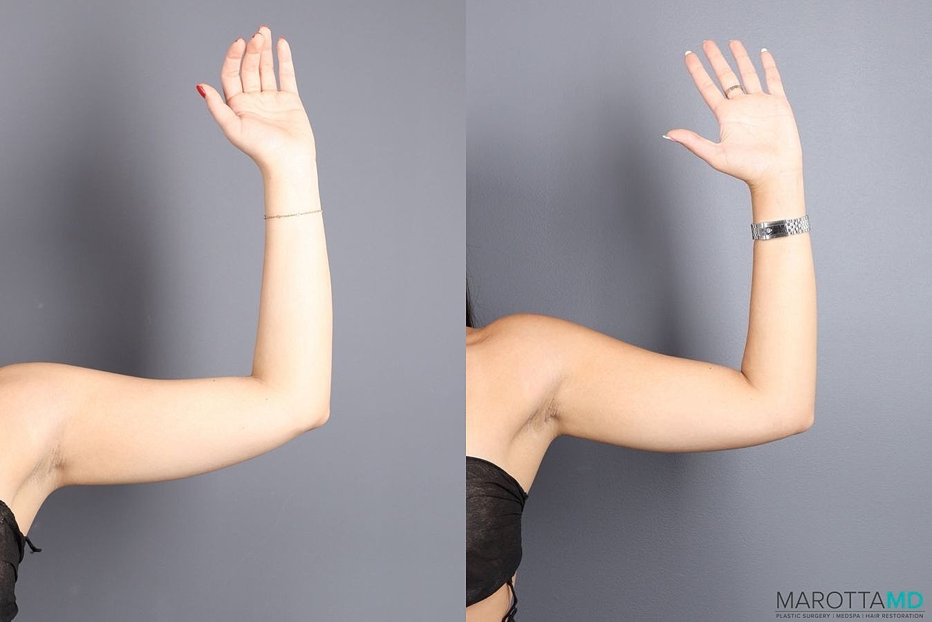 Emsculpt Neo Before & After