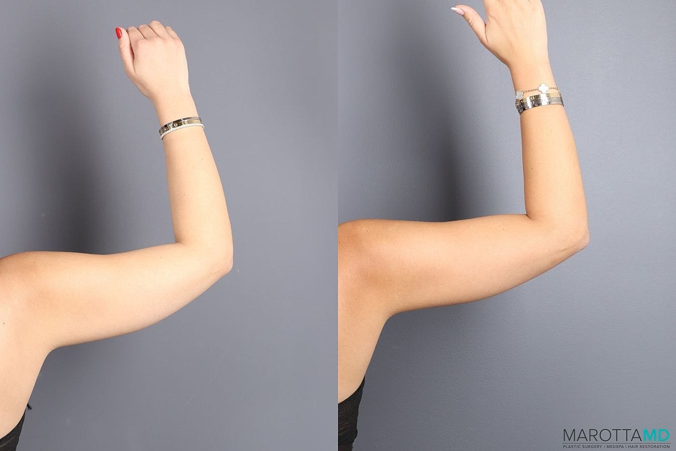 Emsculpt Neo Before & After