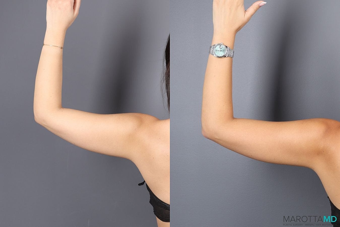Emsculpt Neo Before & After