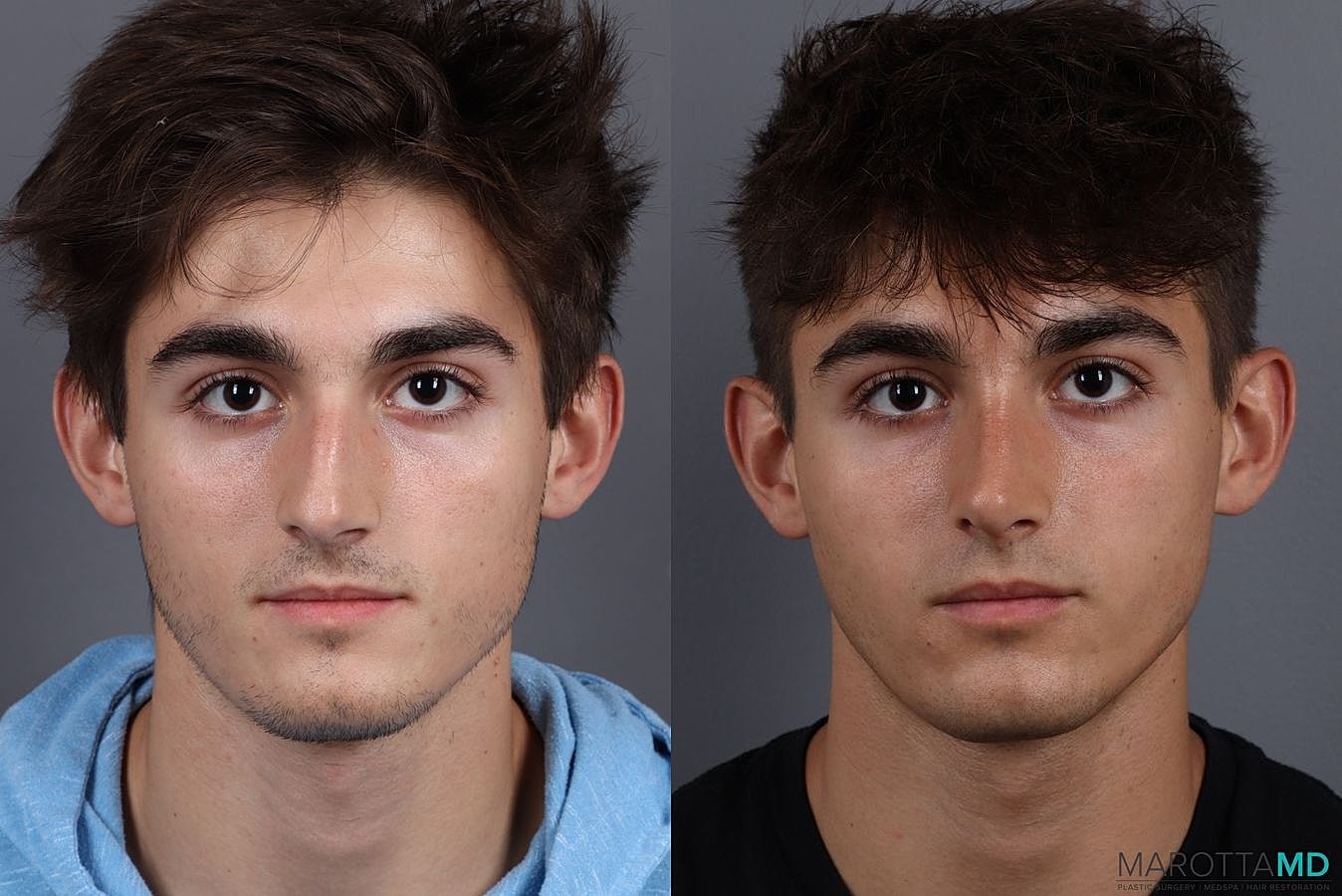 Male Rhinoplasty Before & After