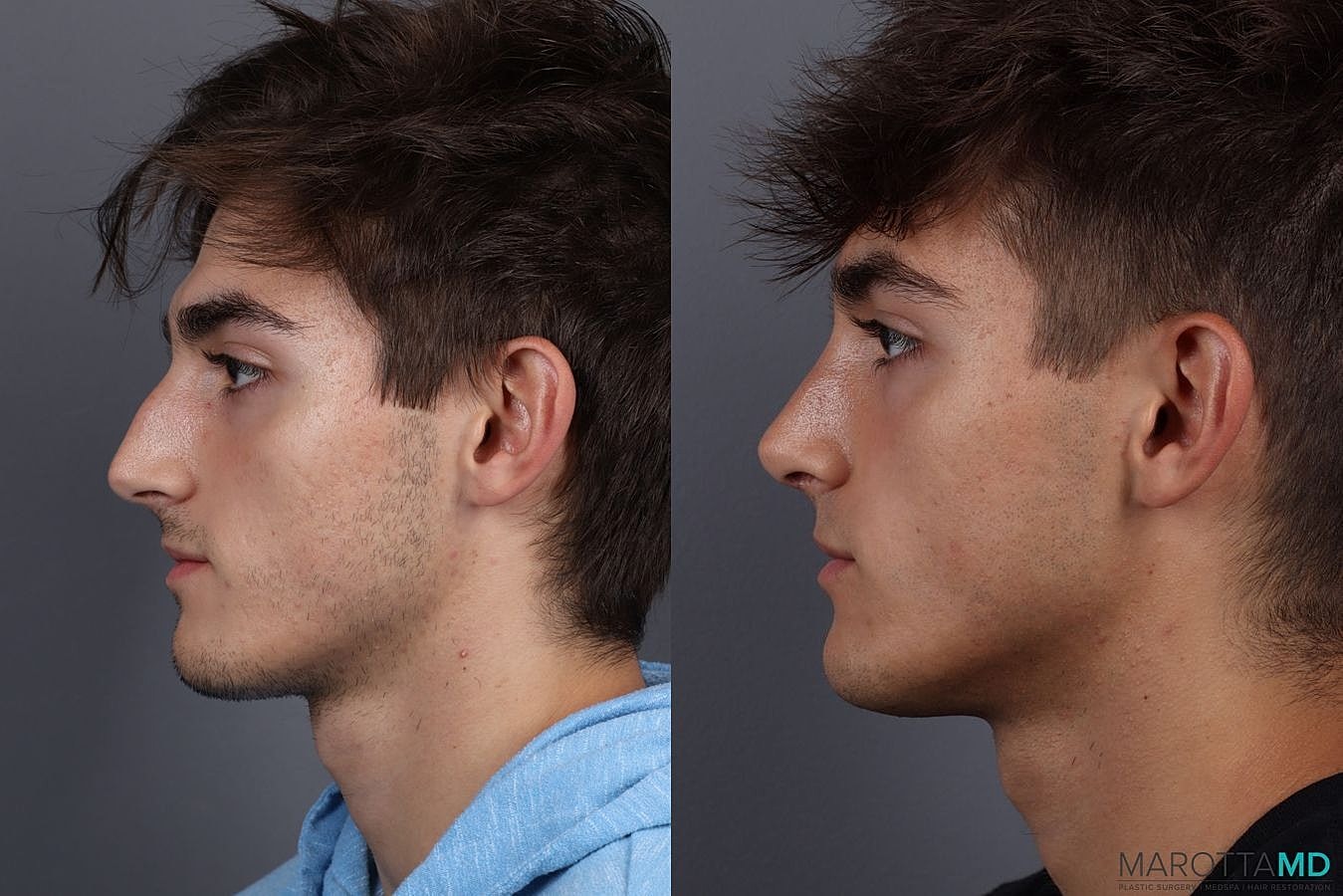 Male Rhinoplasty Before & After