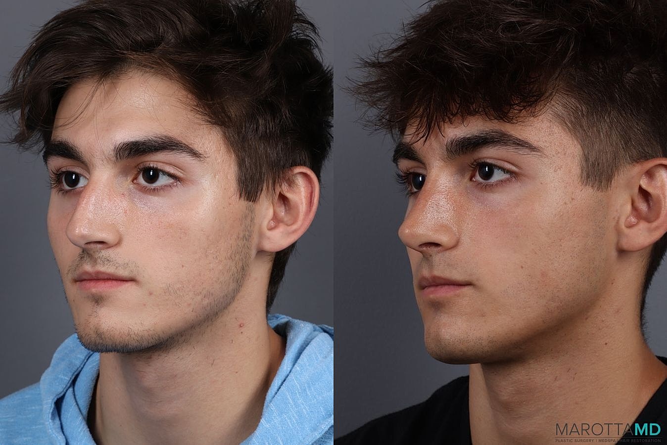 Male Rhinoplasty Before & After