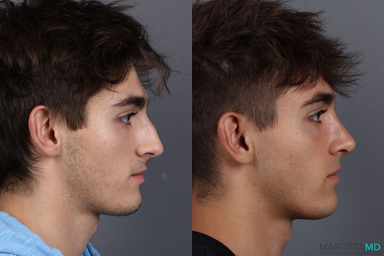 Male Rhinoplasty Before & After