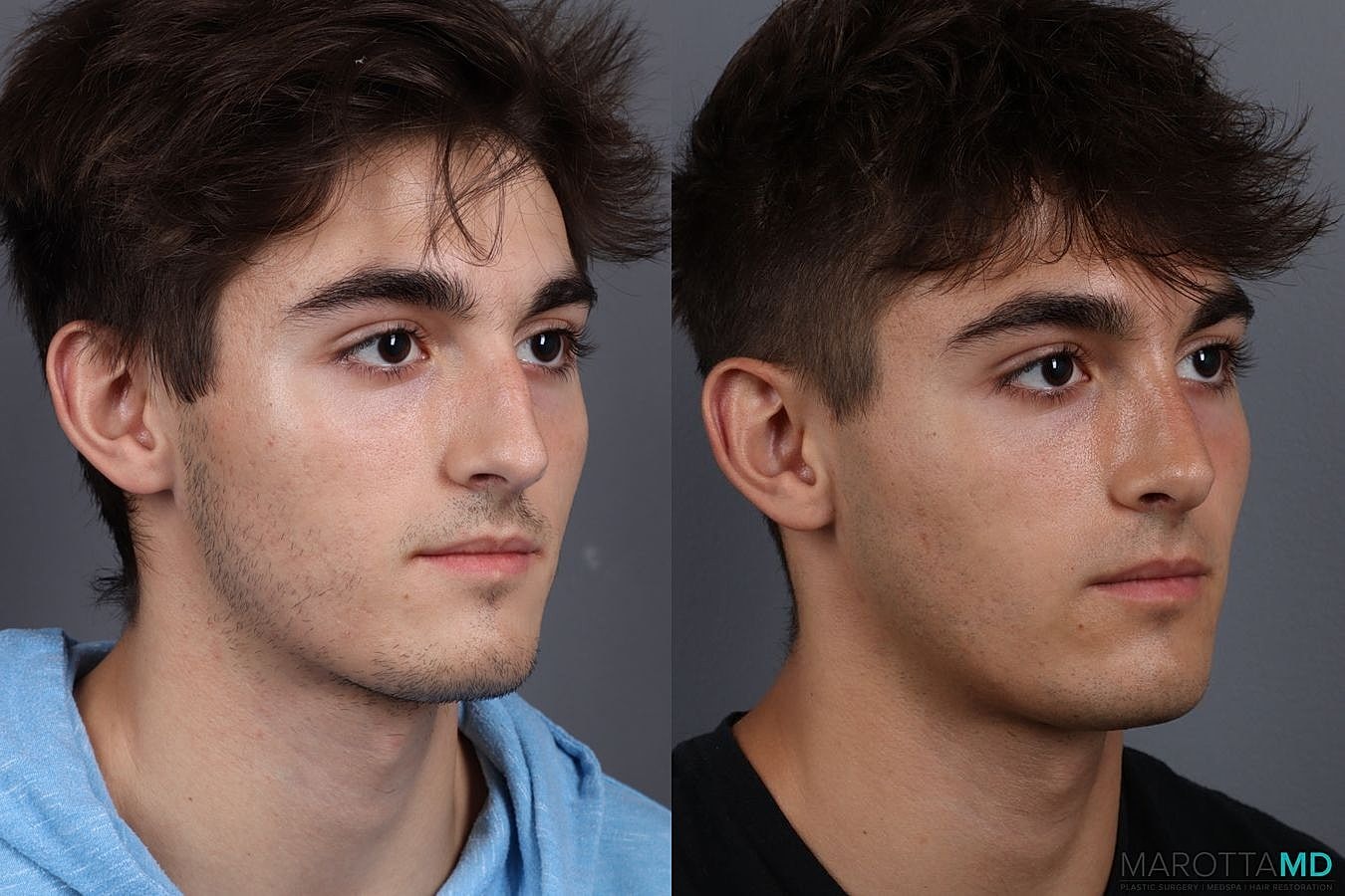 Male Rhinoplasty Before & After
