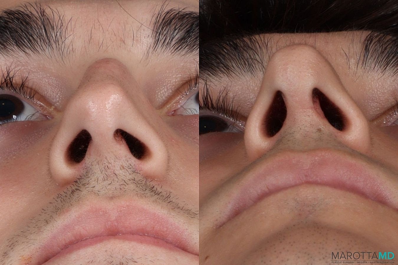 Male Rhinoplasty Before & After