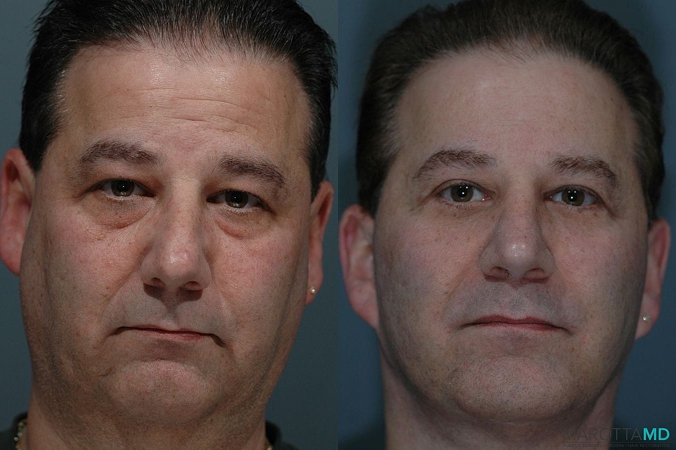 Male Rhinoplasty Before & After