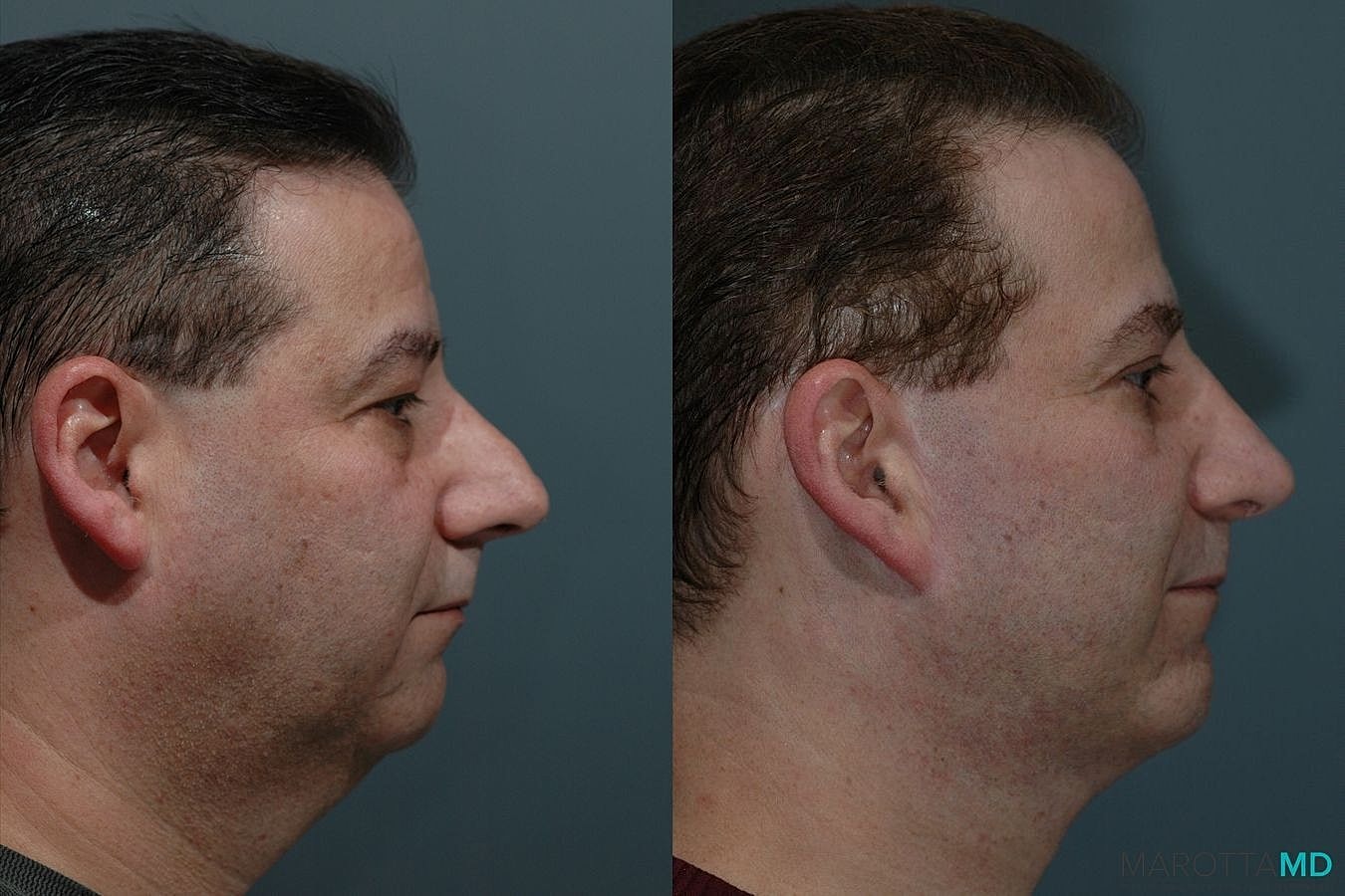 Male Rhinoplasty Before & After