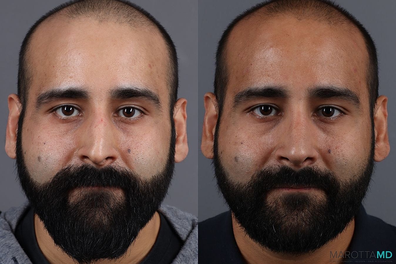 Male Rhinoplasty Before & After