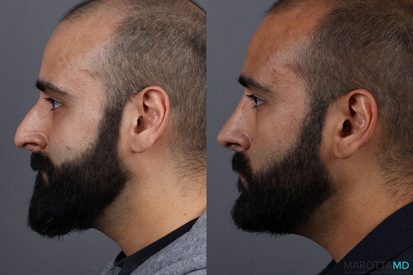 Male Rhinoplasty Before & After