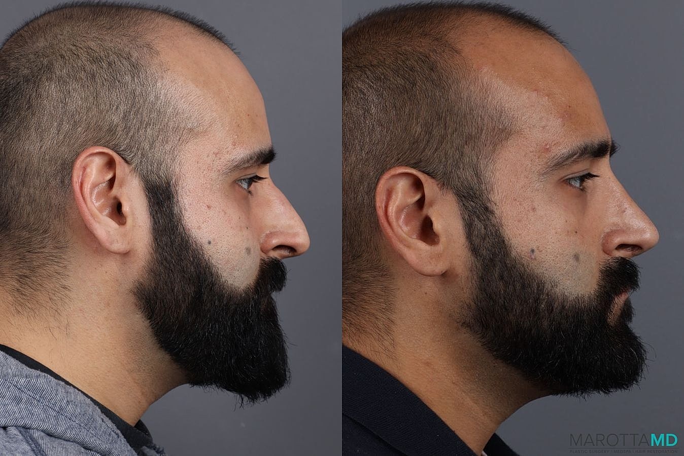 Male Rhinoplasty Before & After