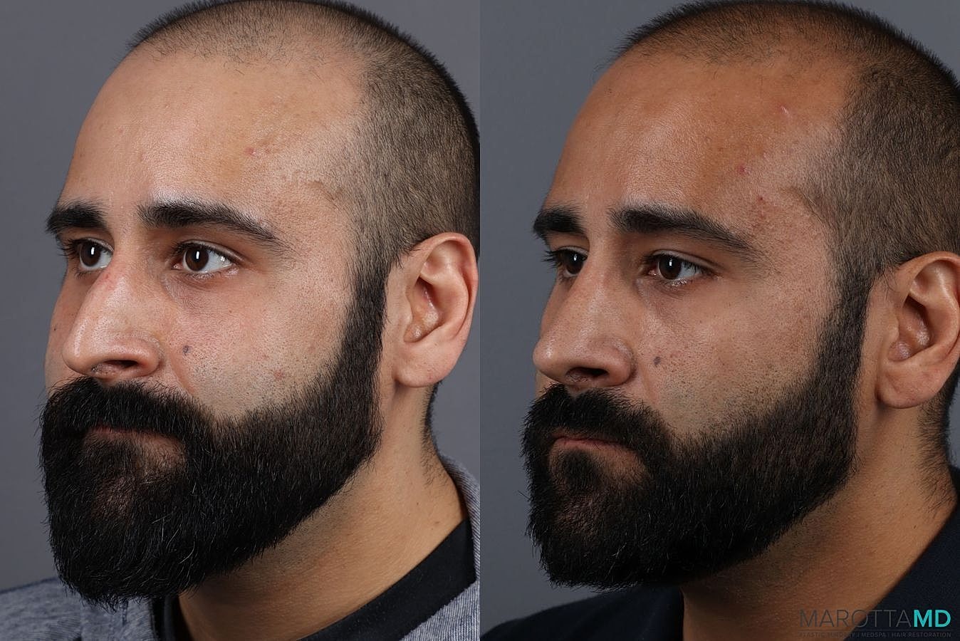 Male Rhinoplasty Before & After