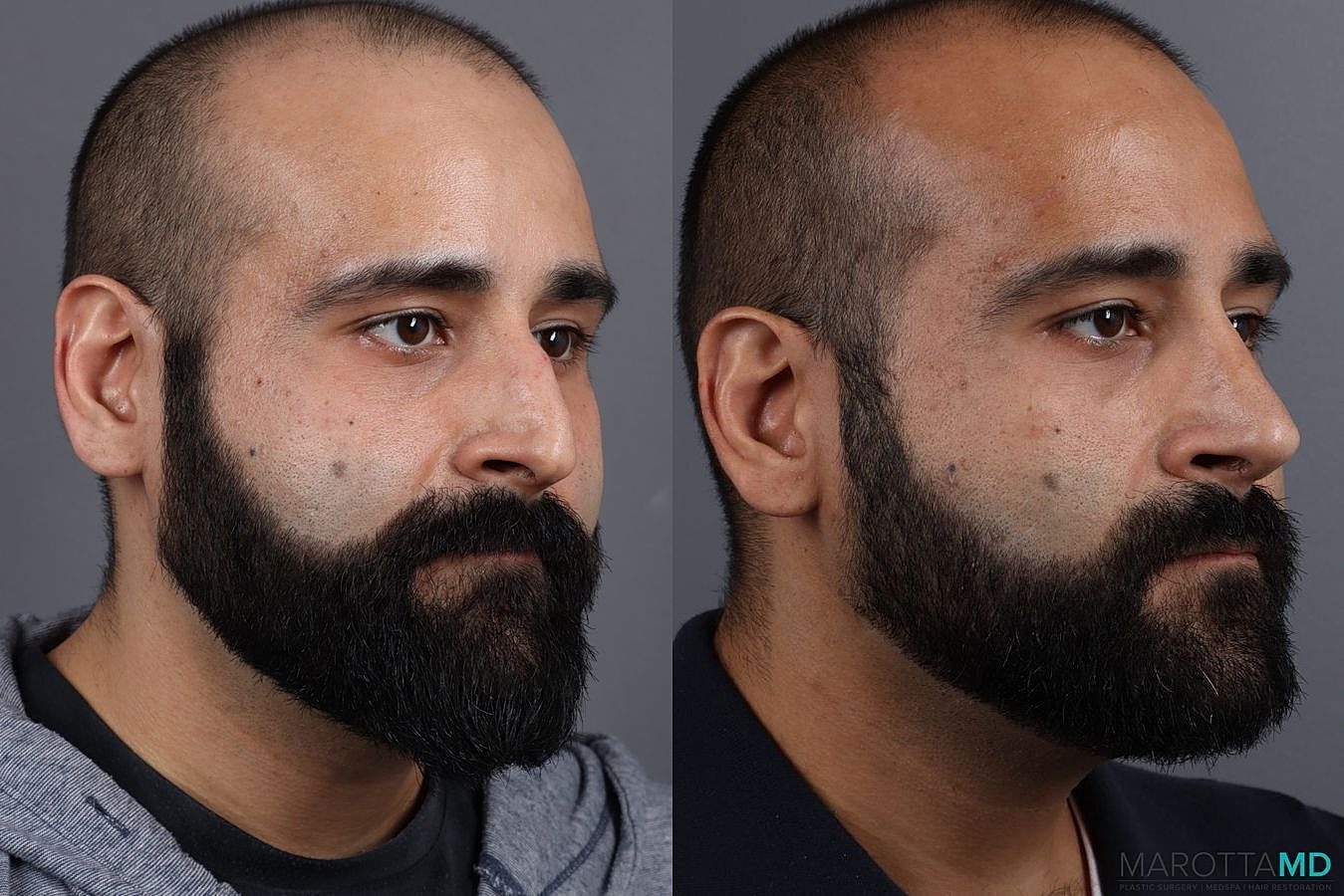 Male Rhinoplasty Before & After