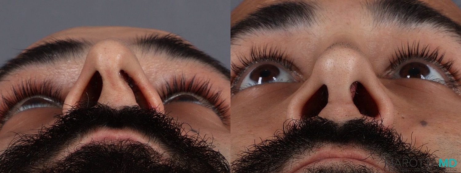 Male Rhinoplasty Before & After