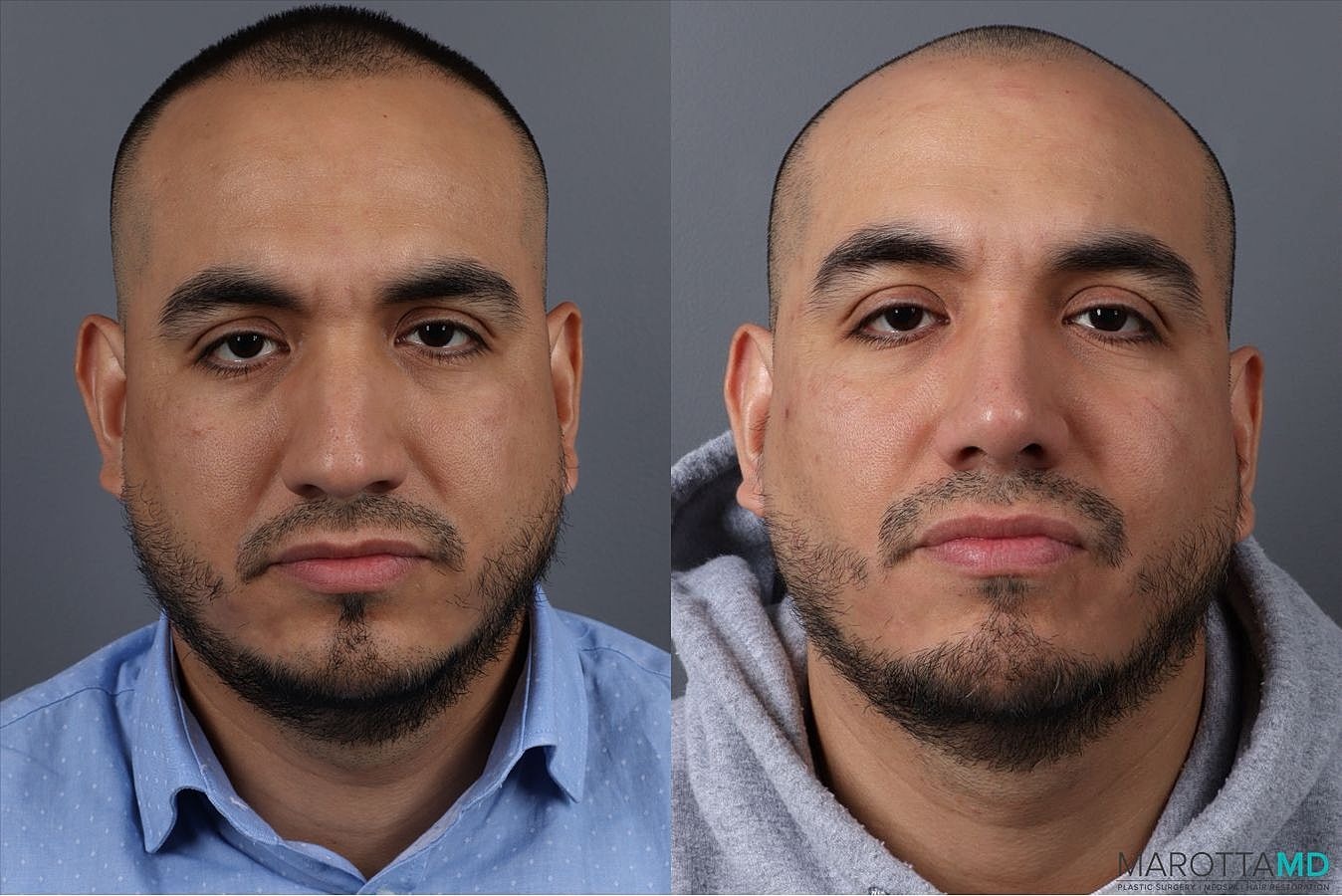 Male Rhinoplasty Before & After