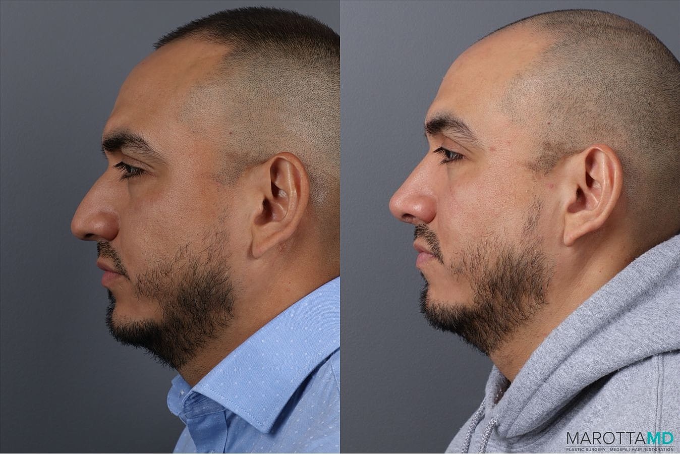 Male Rhinoplasty Before & After