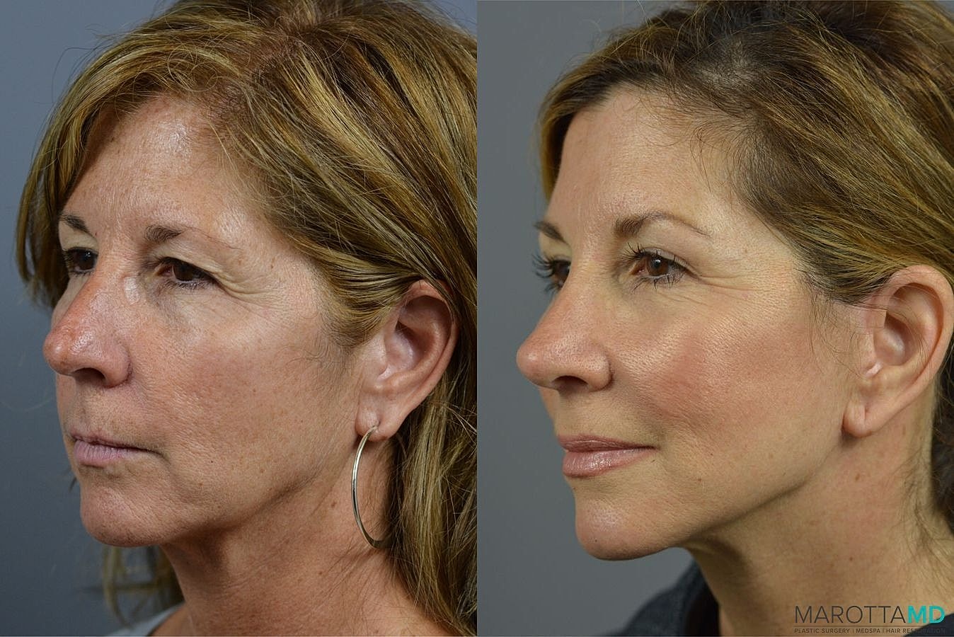 Mini Facelift Before & After
