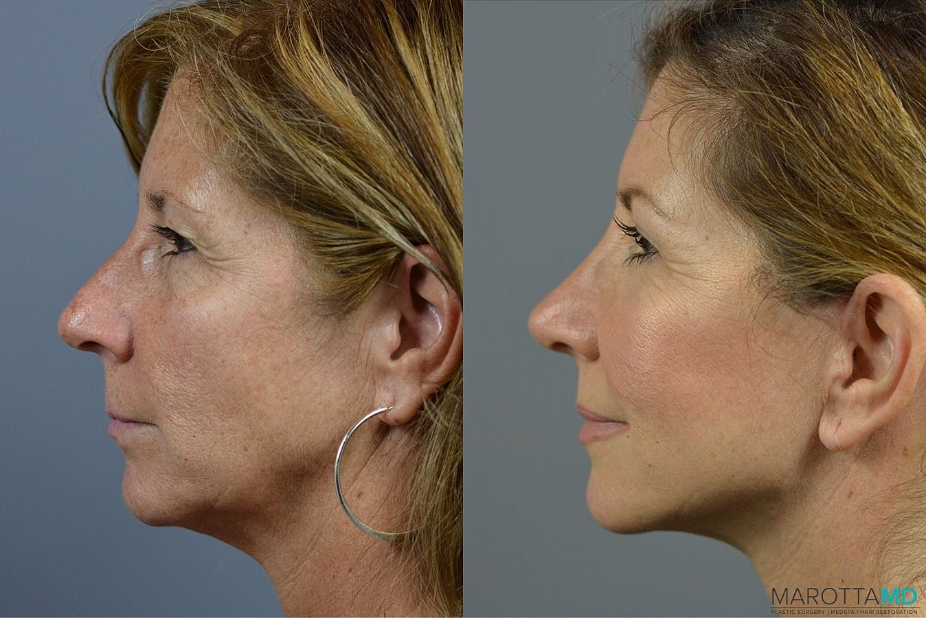 Mini Facelift Before & After