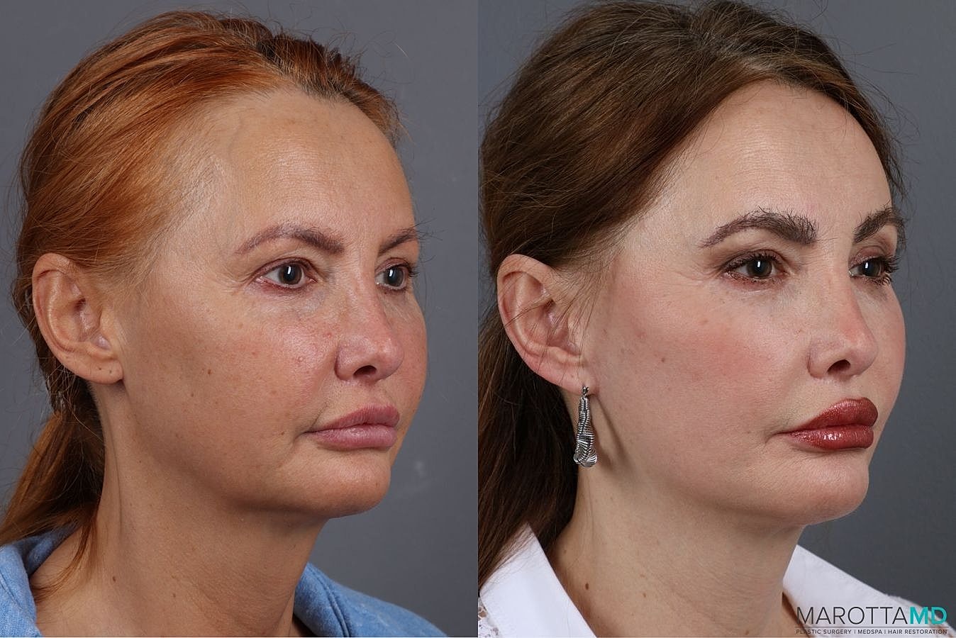 Mini Facelift Before & After
