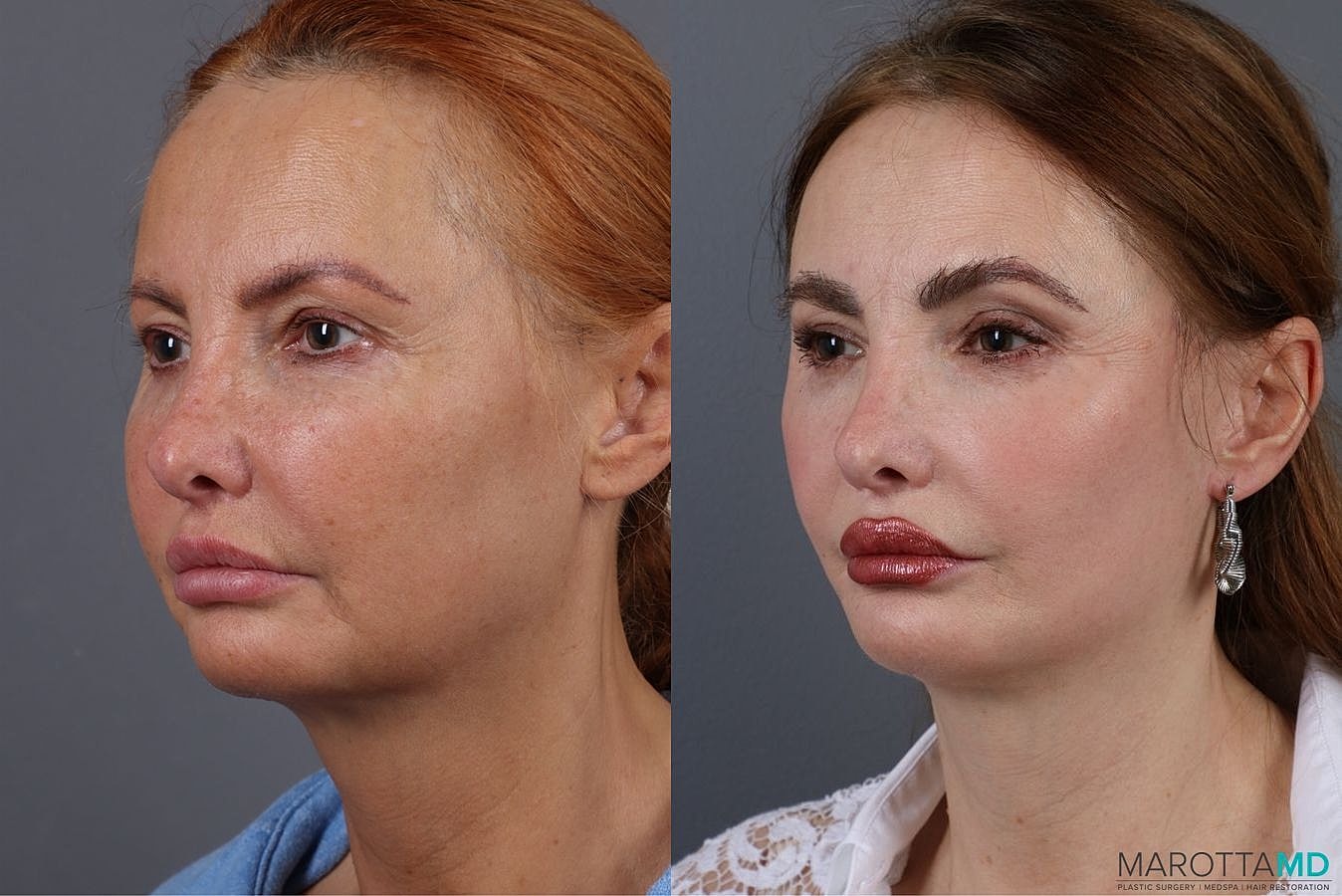 Mini Facelift Before & After