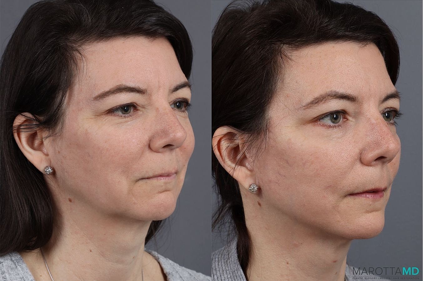 Mini Facelift Before & After