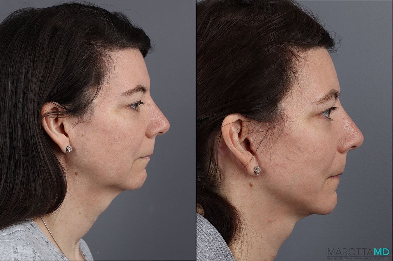 Mini Facelift Before & After