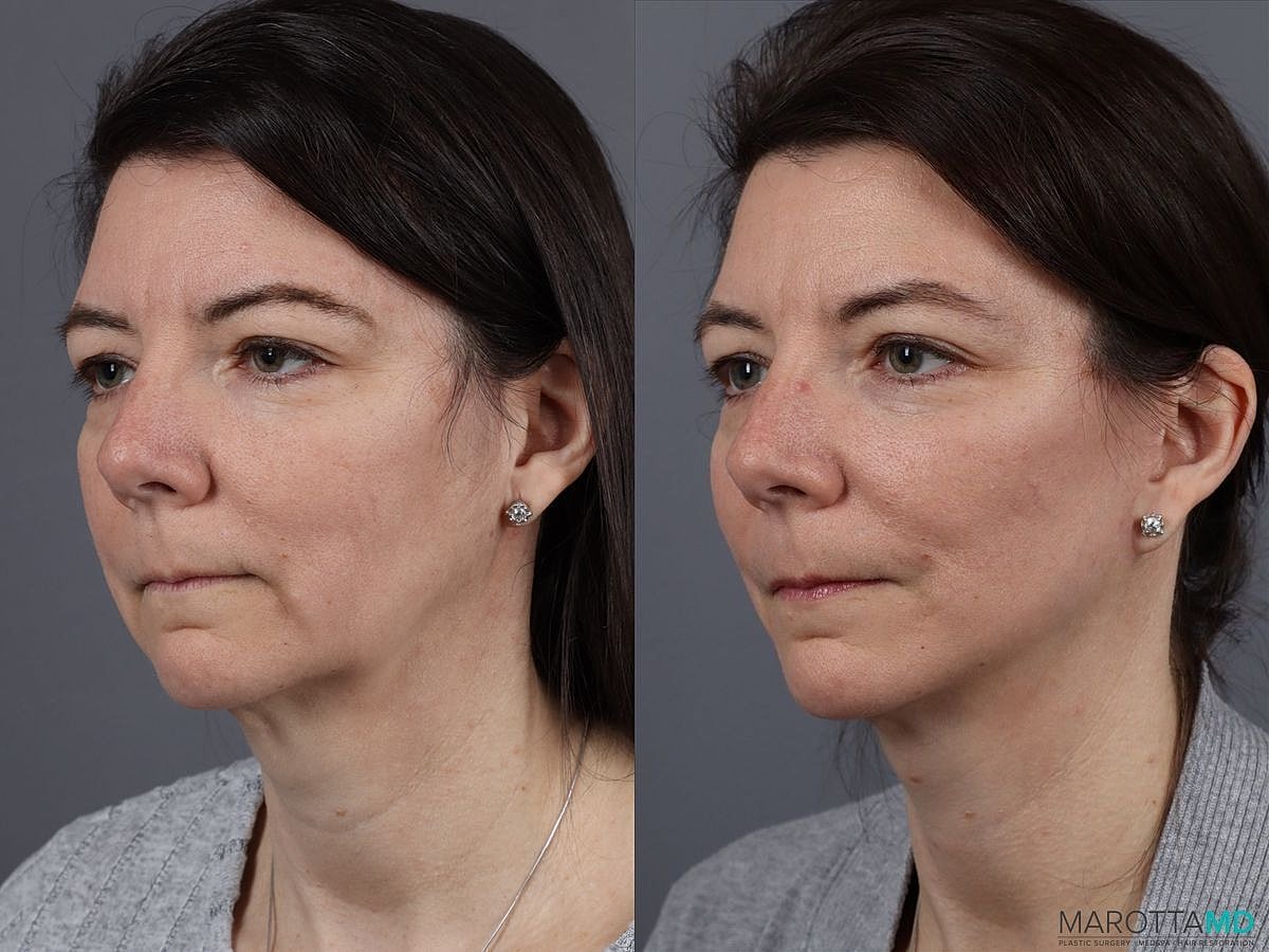 Mini Facelift Before & After