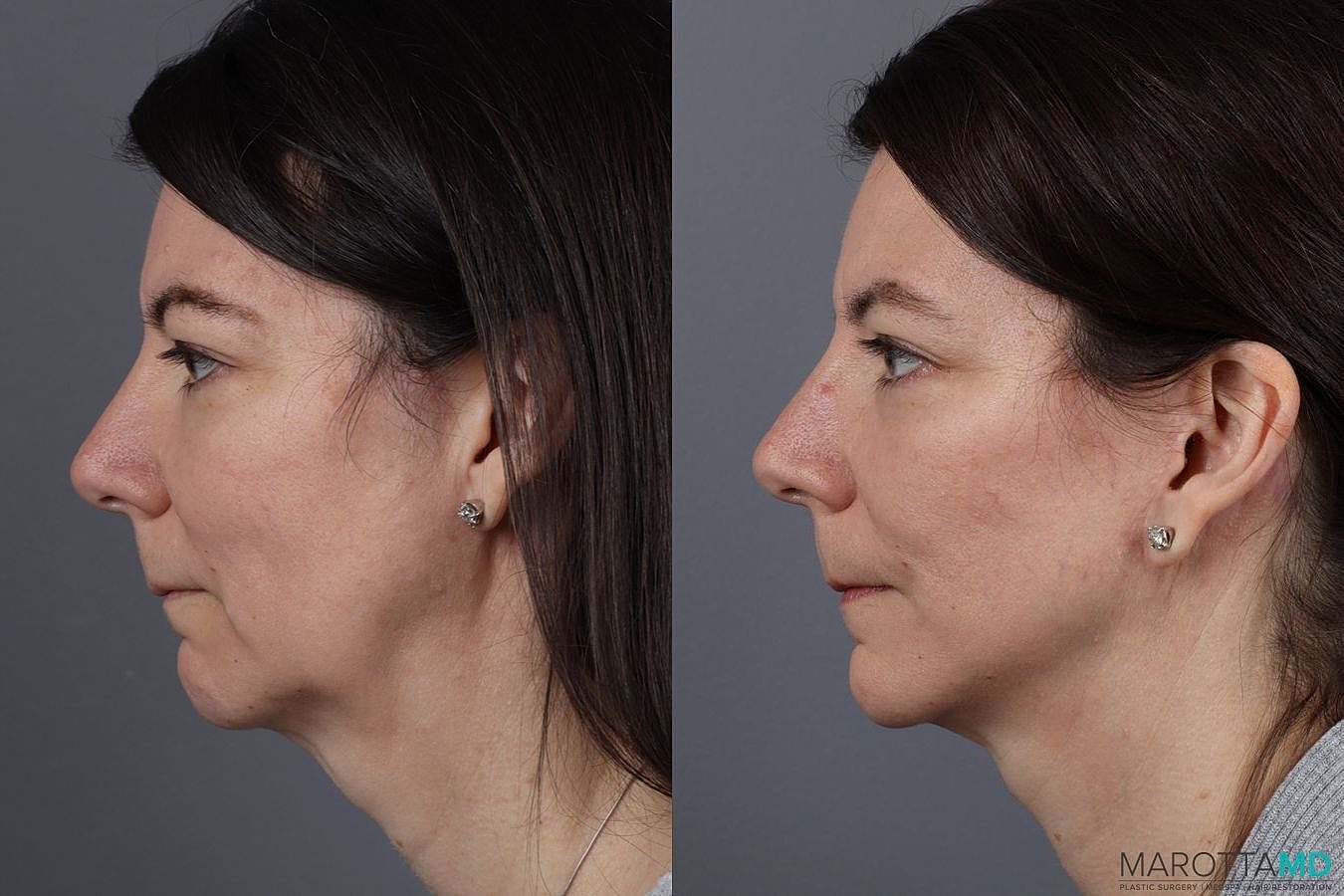 Mini Facelift Before & After