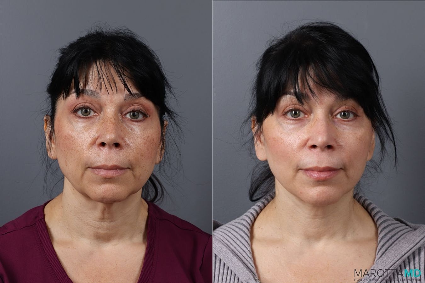 Mini Facelift Before & After