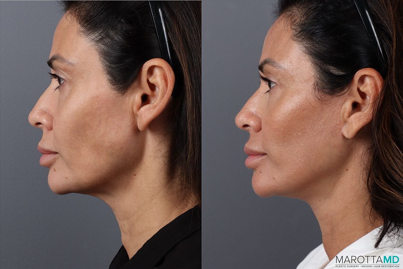 Mini Facelift Before & After
