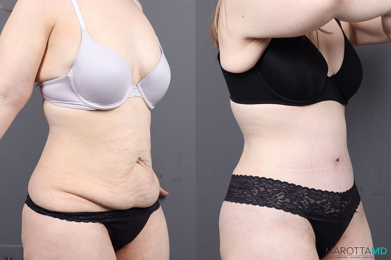 Abdominoplasty Before & After