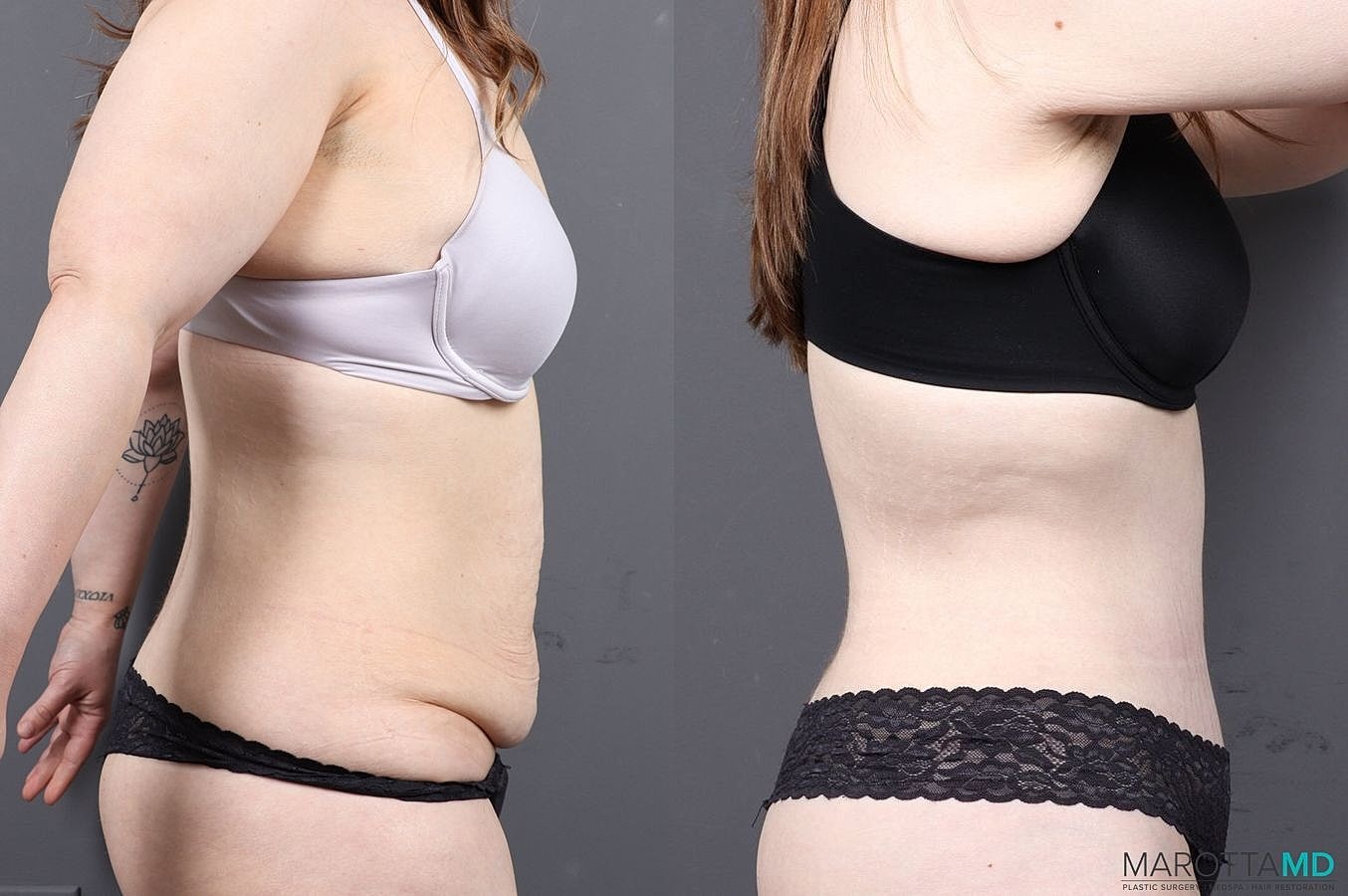 Abdominoplasty Before & After