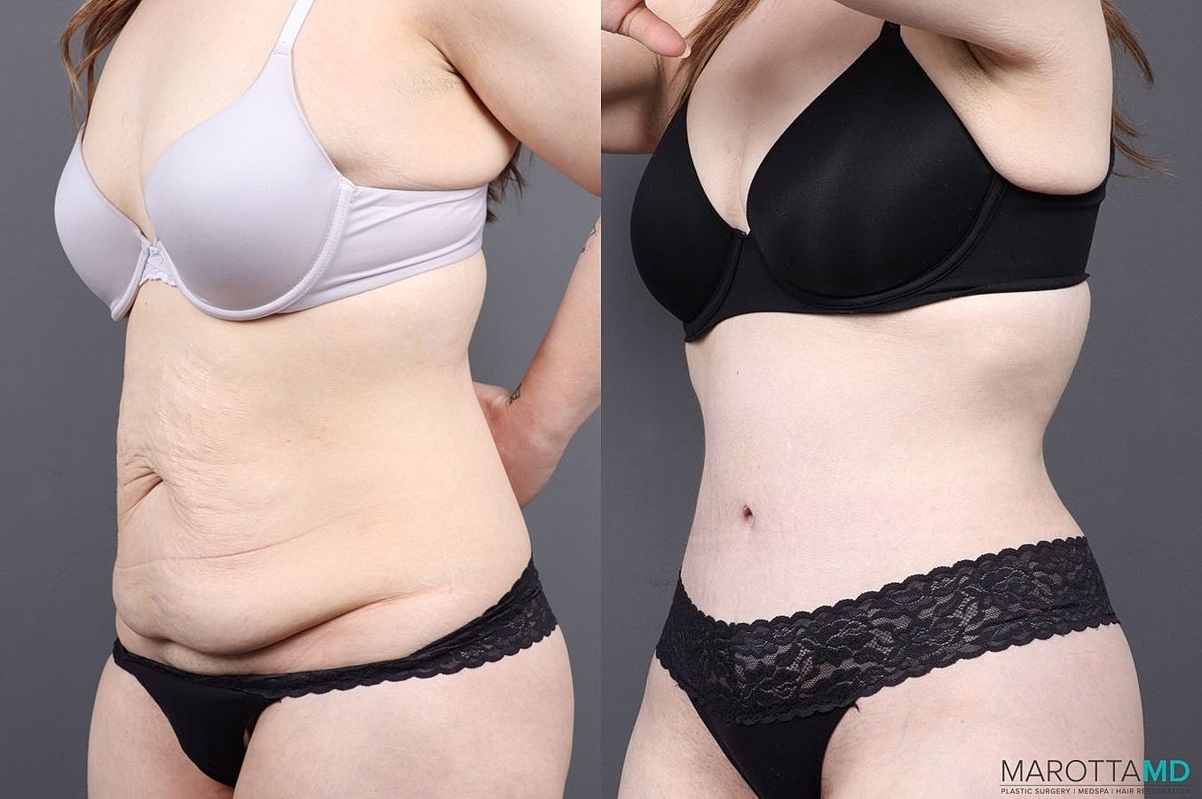 Abdominoplasty Before & After