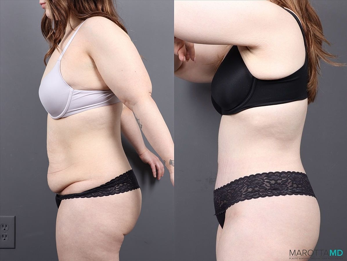 Abdominoplasty Before & After