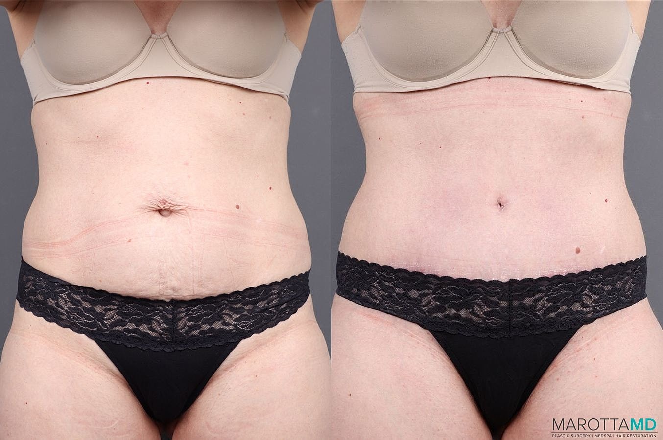 Abdominoplasty Before & After