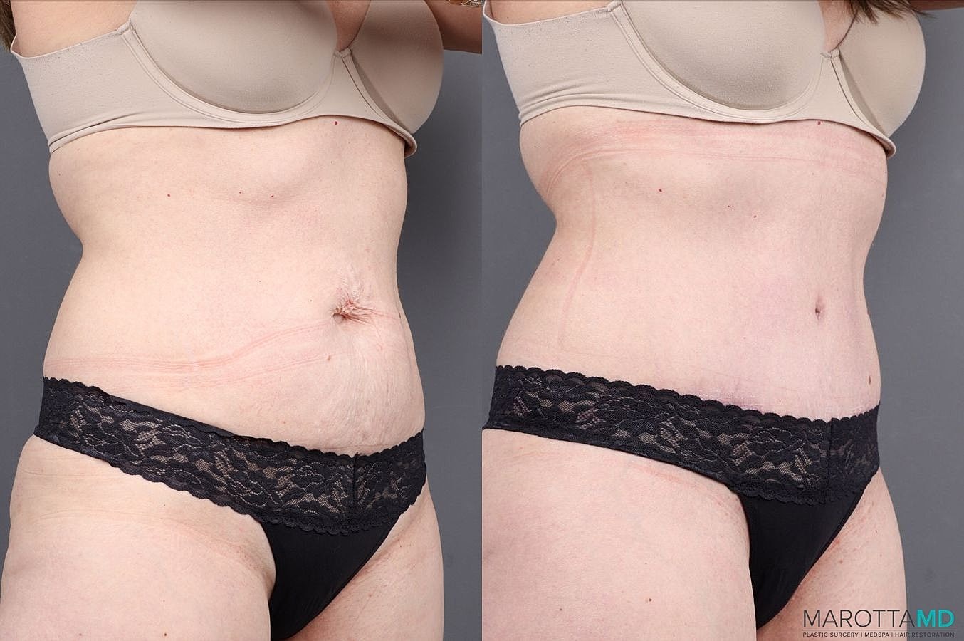 Abdominoplasty Before & After