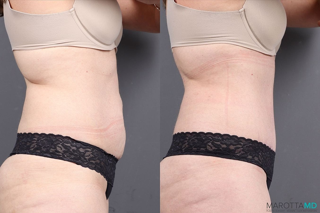 Abdominoplasty Before & After