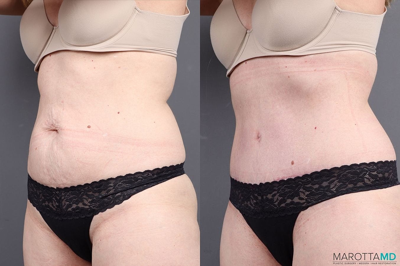 Abdominoplasty Before & After