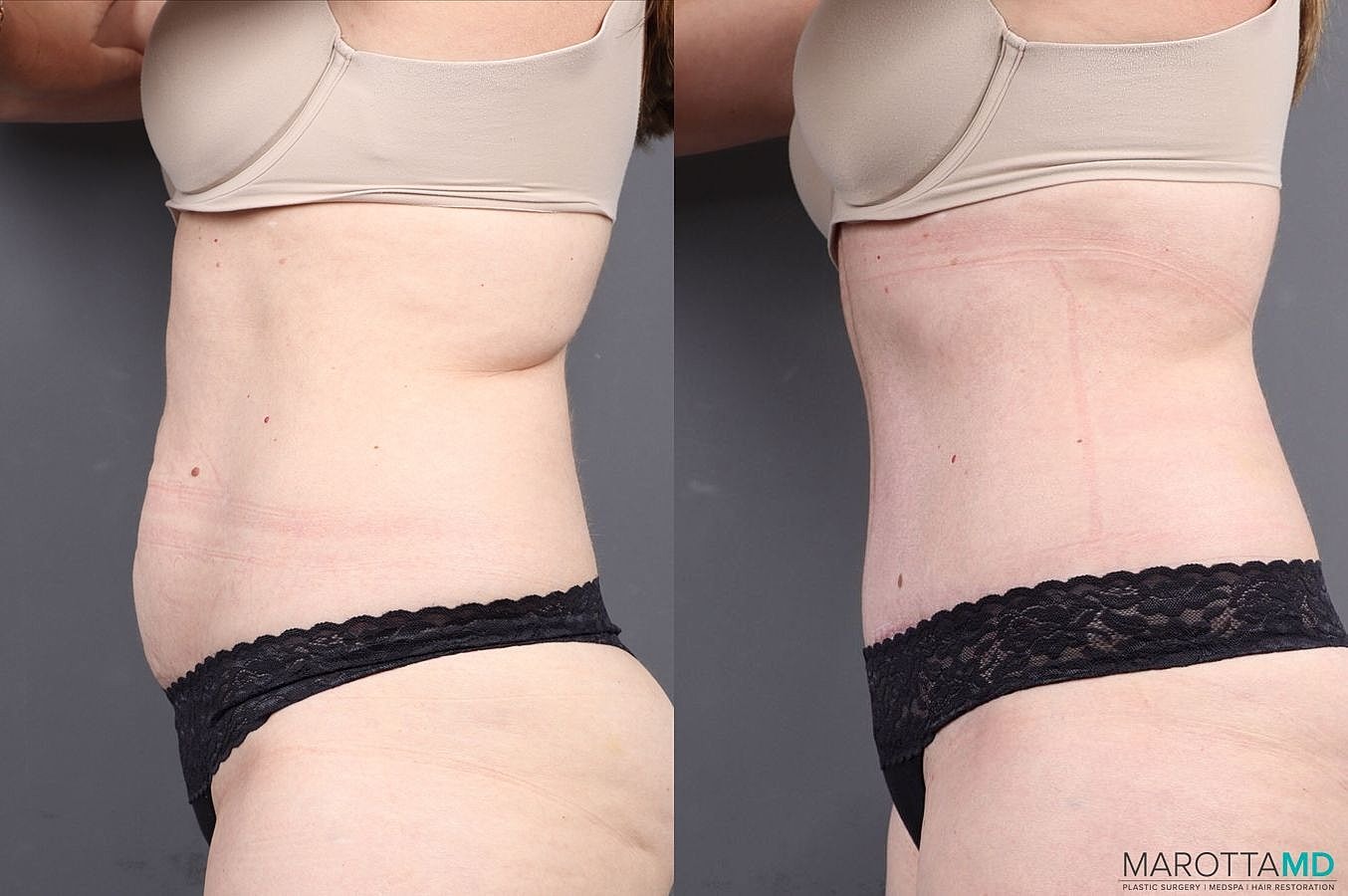 Abdominoplasty Before & After