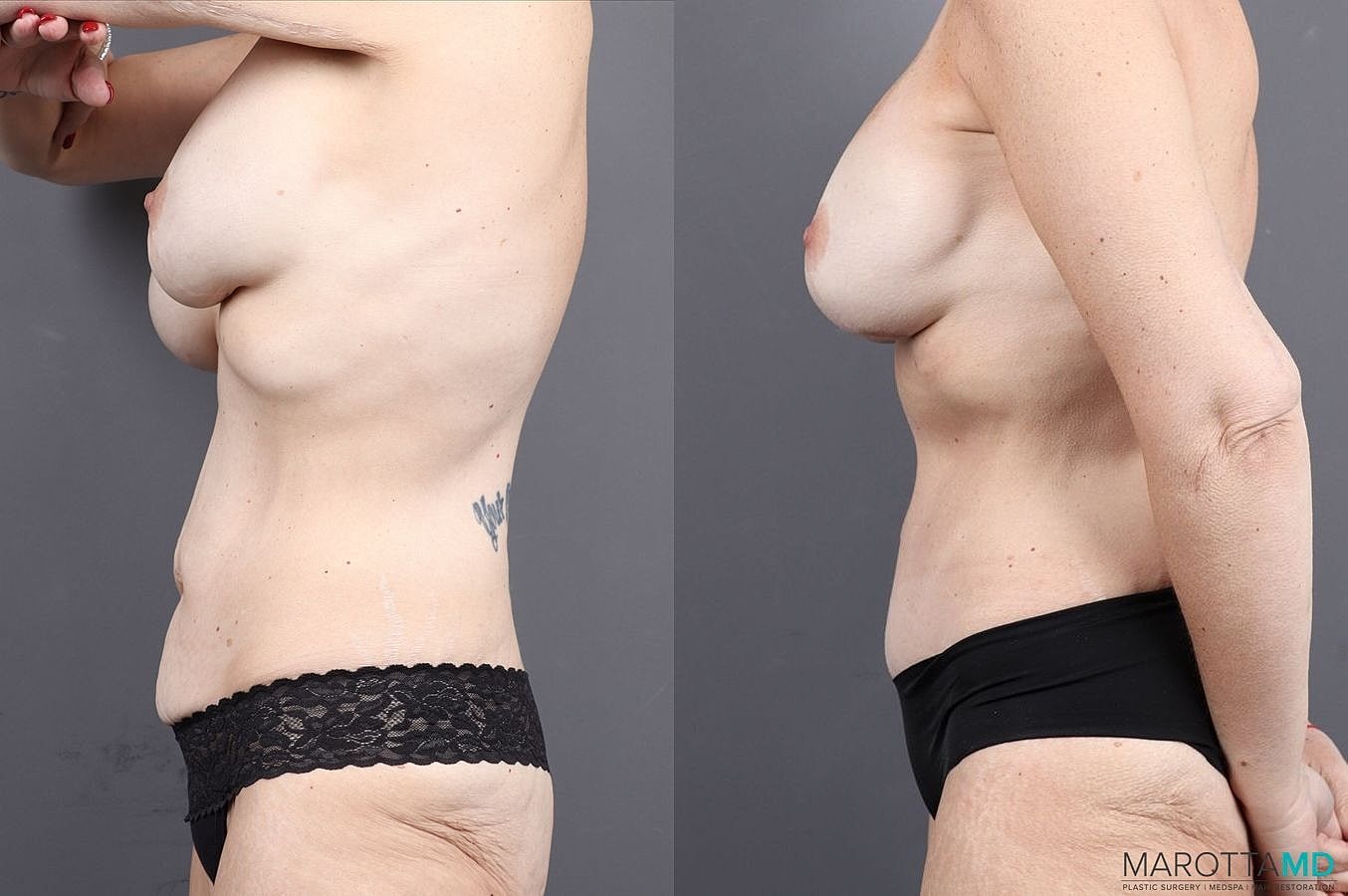 Abdominoplasty Before & After