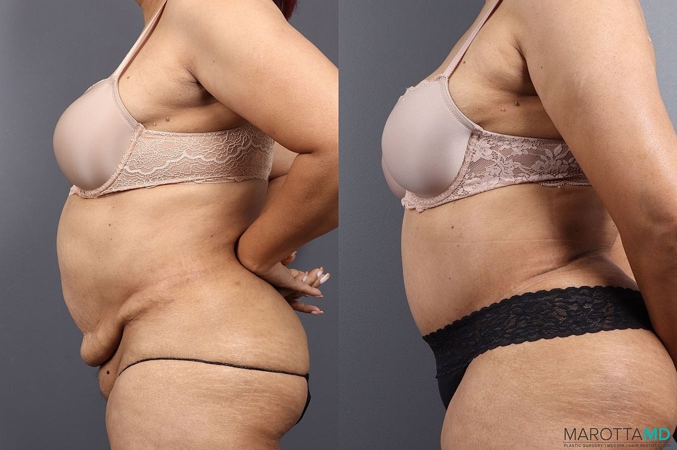 Abdominoplasty Before & After