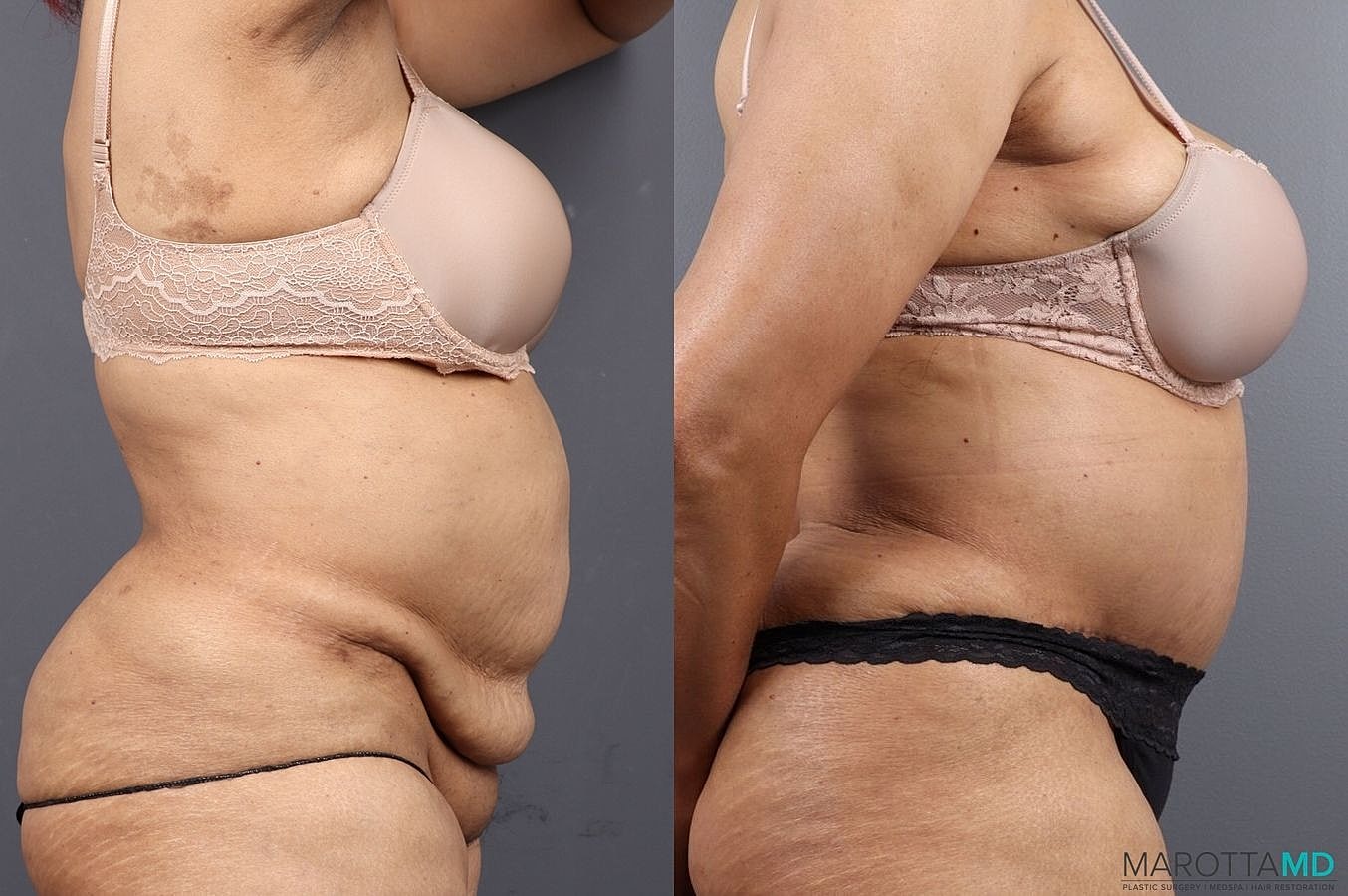 Abdominoplasty Before & After