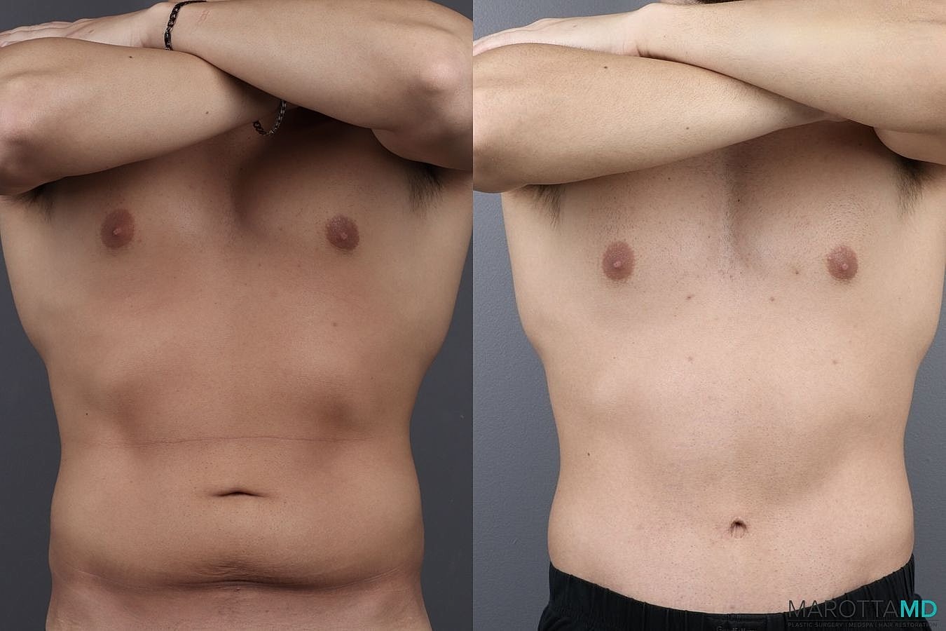 Abdominoplasty Before & After