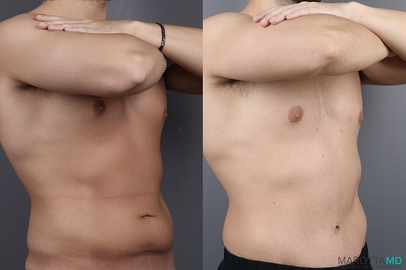 Abdominoplasty Before & After