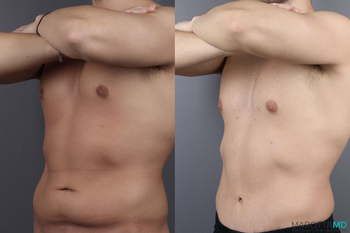 Abdominoplasty Before & After