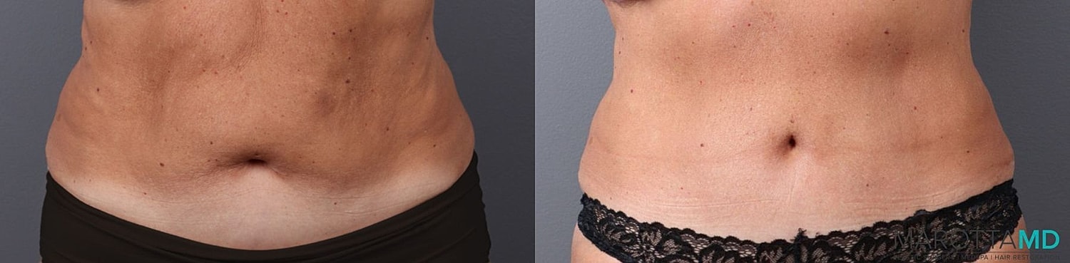 Abdominoplasty Before & After