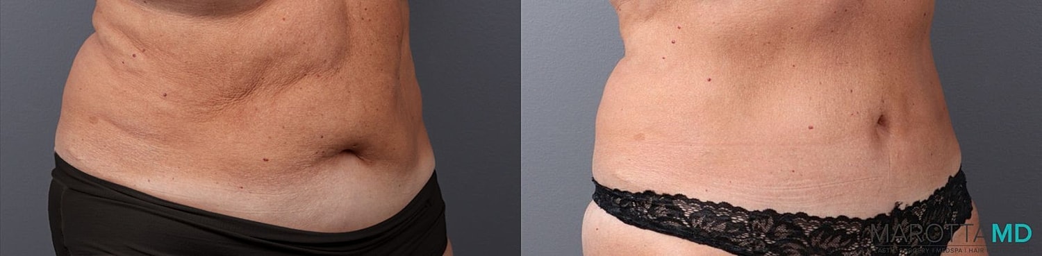 Abdominoplasty Before & After