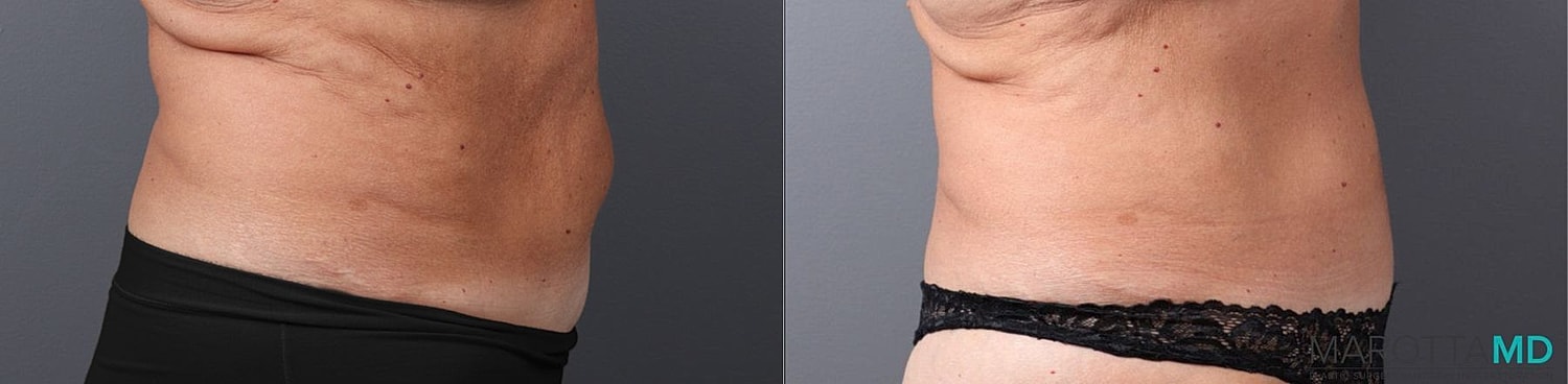 Abdominoplasty Before & After