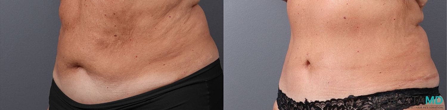 Abdominoplasty Before & After