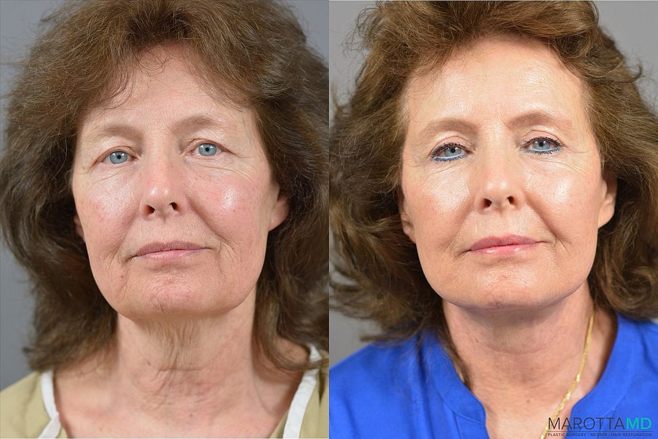 Facelift Before & After